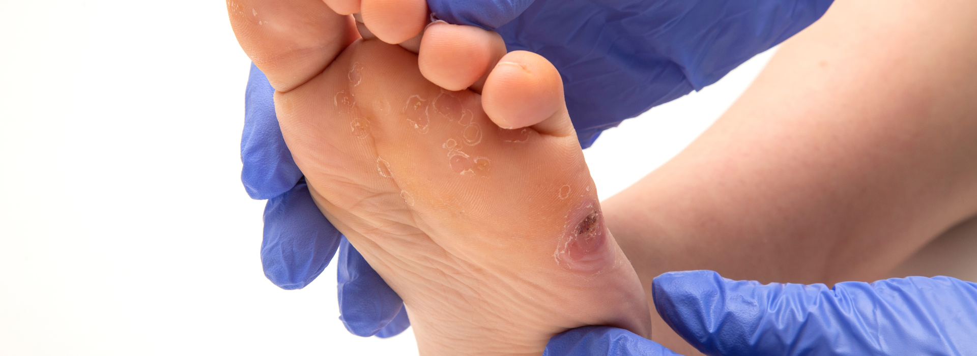 Tratamiento Pie Diabético La Ligua - Evaluación vascular, prevención de úlceras y cuidado especializado